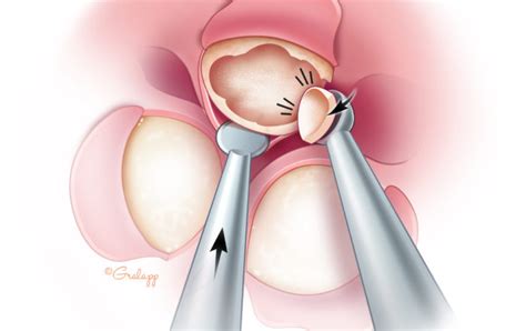 Exostoses of the Ear Canal – Oto Surgery Atlas