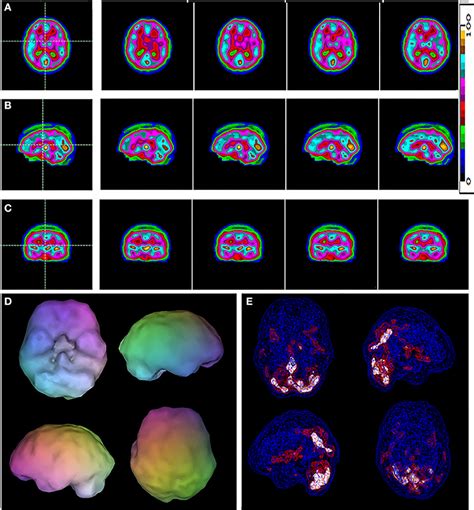 Attention Deficit Disorder Brain Compared To Normal Brain