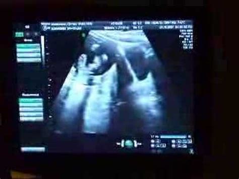 Quadruplets Ultrasound Pictures