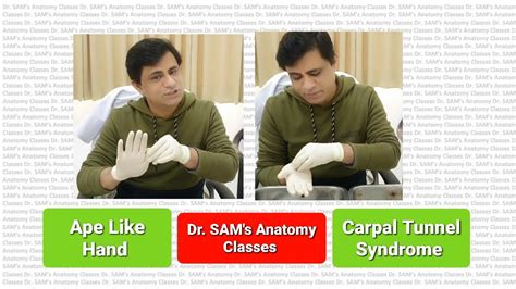 Carpal Tunnel Syndrome Anatomy | Ape Like Hand Deformity | CTS Demonstration on Gross Specimen ...