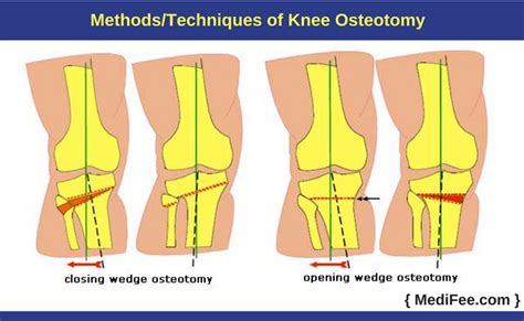 Knee Osteotomy: Surgery and Recovery