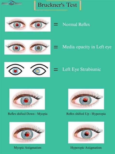 BRUCKNER TEST (FUNDUS RED REFLEX TEST) - OptomInSight