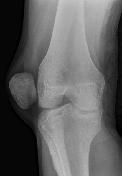 Recurrent Dislocation of Patella | Bone and Spine