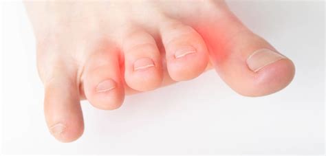 Things You Can Do to Fix Crooked Toes - Palmetto State Podiatry