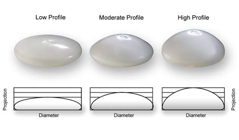 Breast Implant Dimensions & Sizes: Esprit® Cosmetic Surgeons