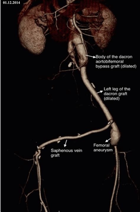 Preoperative CT angiography showing dacron graft dilation (29,4 mm body ...