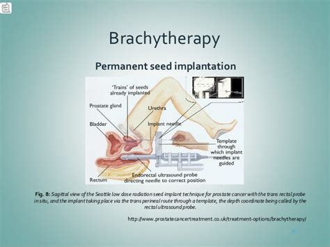 Brachytherapy: Prostate Cancer