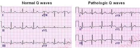 Inferior myocardial infarction ECG Review | LearntheHeart.com