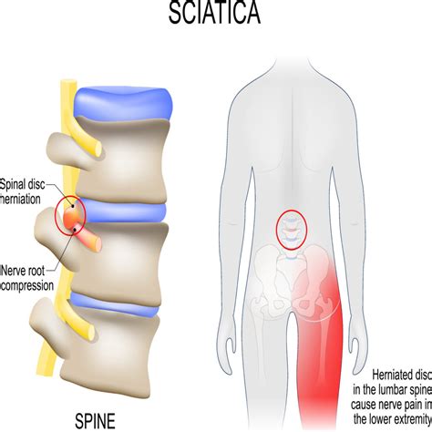 Sciatica: Causes, Symptoms, Treatment & Prevention