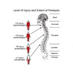 Quadriplegia Injury | Napolin Accident Injury Lawyer