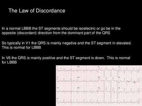 Lbbb + sgarbossa