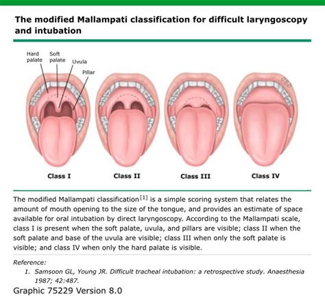 Mallampati Classification Airway Obstruction | Basic anatomy and physiology, Nursing student ...