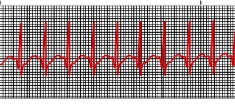 Paroxysmal Atrial Tachycardia Vs Sinus Tachycardia