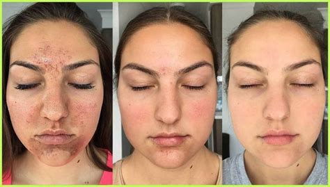 My Accutane Experience + How I Got Clear Skin (Before + After ... | Makeup Trend ...