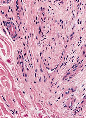 Pathology Outlines - Histology-fibrous tissue & nerve