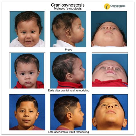 Craniosynostosis Gallery - Dell Children's Craniofacial Team of Texas