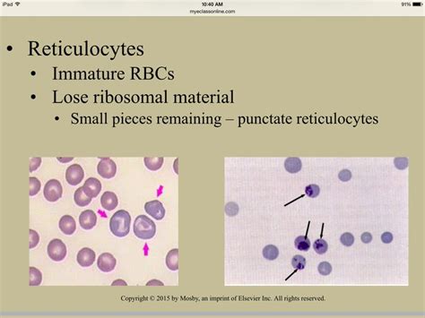 92 best Hereditary Spherocytosis (Rare Blood Disorder) images on Pinterest | Hemolytic anemia ...