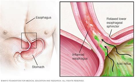 Reflux gastro-œsophagien (RGO) - santemedicals.com