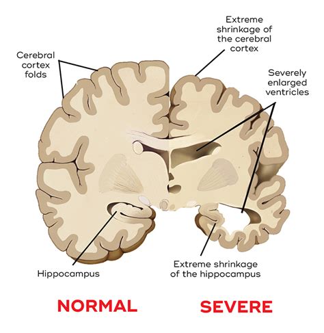 What causes dementia? - Queensland Brain Institute - University of ...