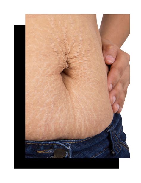 NON-SURGICAL TUMMY TUCK - SONA MD - Botox, Dermal Fillers Kamloops