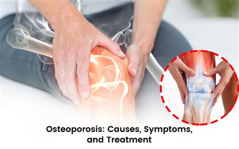 Osteoporosis: Causes, Symptoms, and Treatment - The Newtown Clinic