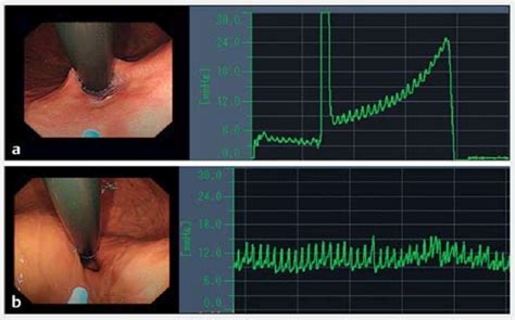 EPSIS (Endoscopic pressure study integrated system) | 【公式】昭和大学 江東豊洲病院 消化器センター