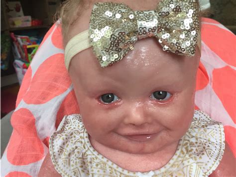 Baby girl has a rare skin condition called harlequin ichthyosis ...