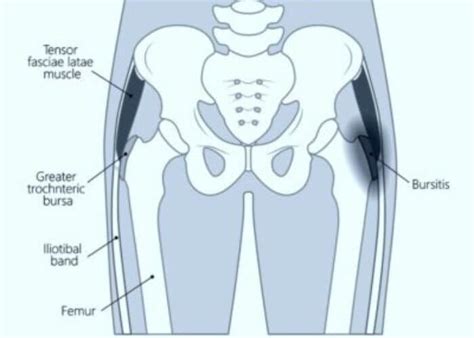 Trochanteric Bursitis Surgery