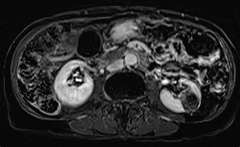 Angiomyolipoma (AML) of kidney - Body MR Case Studies - CTisus CT Scanning