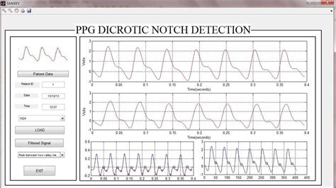 GUI for Dicrotic Notch Detection | Download Scientific Diagram