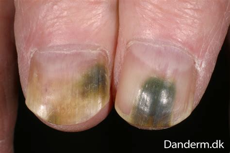 Pseudomonas Aeruginosa Nail Infection - Nail Ftempo