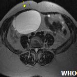 Benign multicystic peritoneal mesothelioma in a postmenopausal woman complicated with an ovarian ...