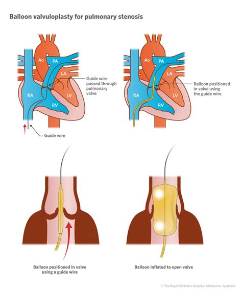 Cardiology : Pulmonary Stenosis