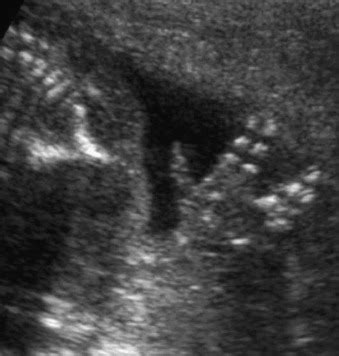 Roberts Syndrome | Radiology Key