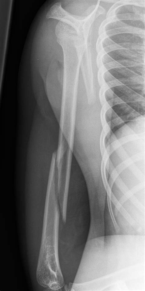 Fractures - Humerus