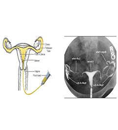 Hysterosalpingogram | NU Hospitals