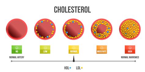 Symptoms of High Cholesterol in Females