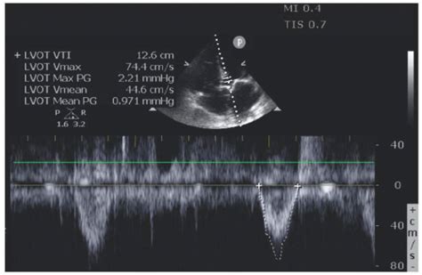 Pulse Wave Velocity Vs Continuous Wave Doppler - Patton Hatintibleat