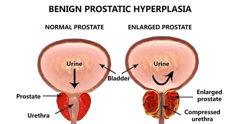 Managing Benign Prostate Hyperplasia & Peyronie’s Disease: A Urologist Discusses - DoctorxDentist