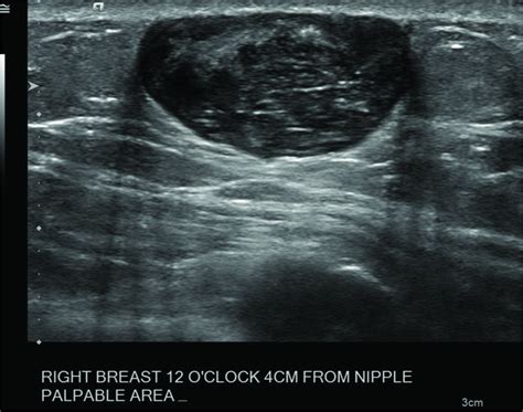 Epidermoid Cyst