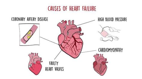 Causes of heart failure - MEDizzy