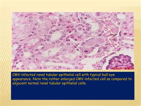 Cytomegalovirus | PPT