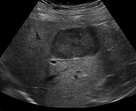 Abdomen and retroperitoneum | 1.1 Liver : Case 1.1.1 Focal nodular hyperplasia and hepatic ...