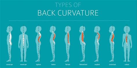 FAQs about Flatback Syndrome