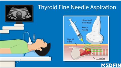 Thyroid: Diagnosis, Treatment and Recovery Explained