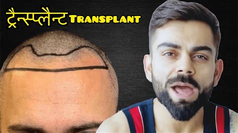 Virat Kohli|Case study|Hair transplant?| Results| Minoxidil ...