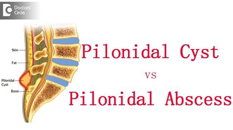 Pilonidal Cyst Histology