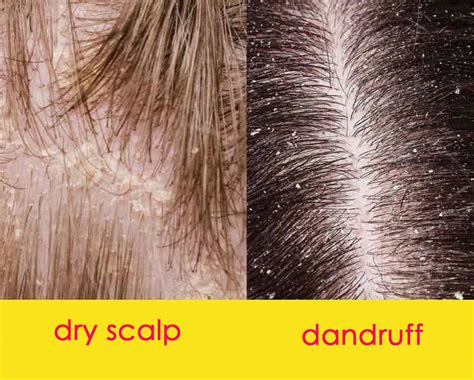 What Is Dandruff Differences Between Dandruff Vs Dry Scalp | My XXX Hot Girl