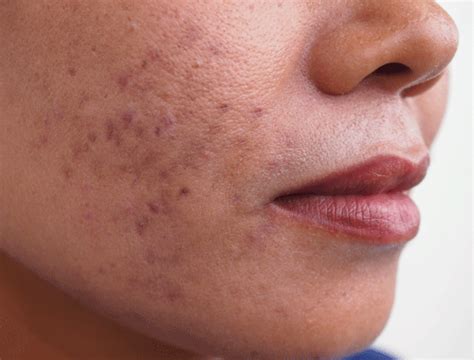 Microneedling For Pigmentation - Aesthetic Skin & Anti-aging Authority