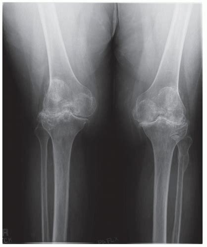 Flexion Contracture | Musculoskeletal Key